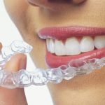 7 Reasons Teens Like Invisalign