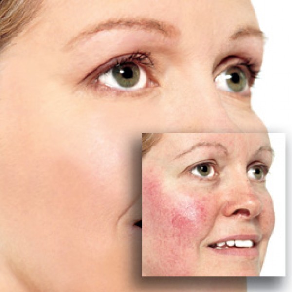 Dry, Red Patches On Your Skin Rosacea Or Eczema Could Be The Culprit