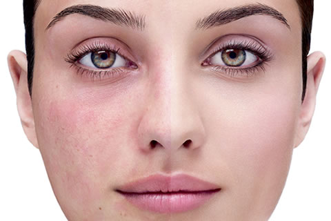 Adult Acne The Myths About Acne Flair-Ups Debunked!
