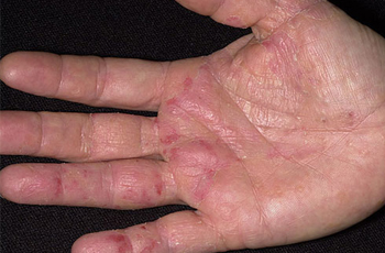 3 Eczema Treatment Options