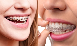 Invisalign Vs Braces